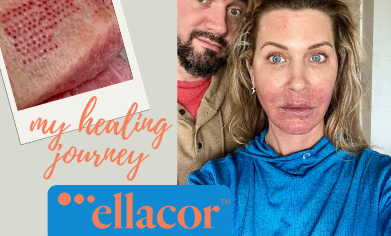 My ellacor™ healing journey (with healing progress photos and tips!)