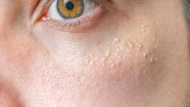 All About Milia: Those Tiny White Bumps Under Your Skin