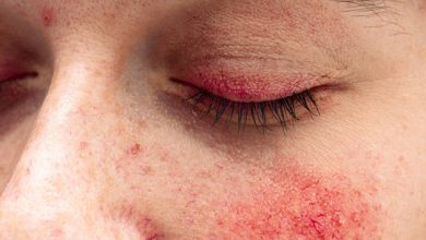 Demodex Mites and Rosacea: Treatment Methods and Causes