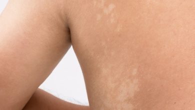 What are White Spots on Skin: Causes & Treatments