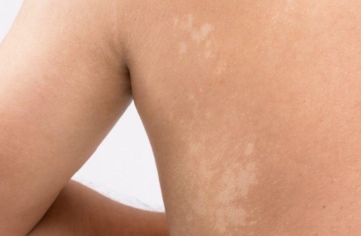 What are White Spots on Skin: Causes & Treatments