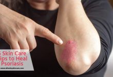 Best Skin Care to Heal Psoriasis